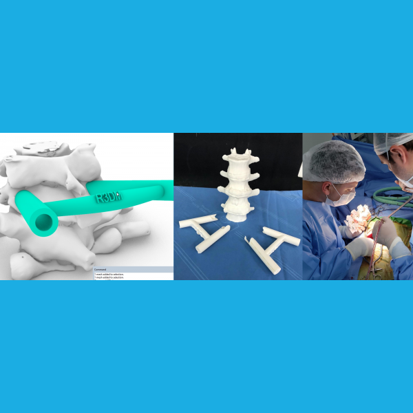 Software to easily create 3D printable models and guides for spine surgery